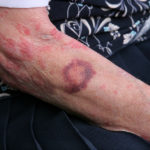 bruising on an elderly lady signs of abuse